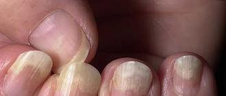 Por que aparecem listras longitudinais e transversais nas unhas?